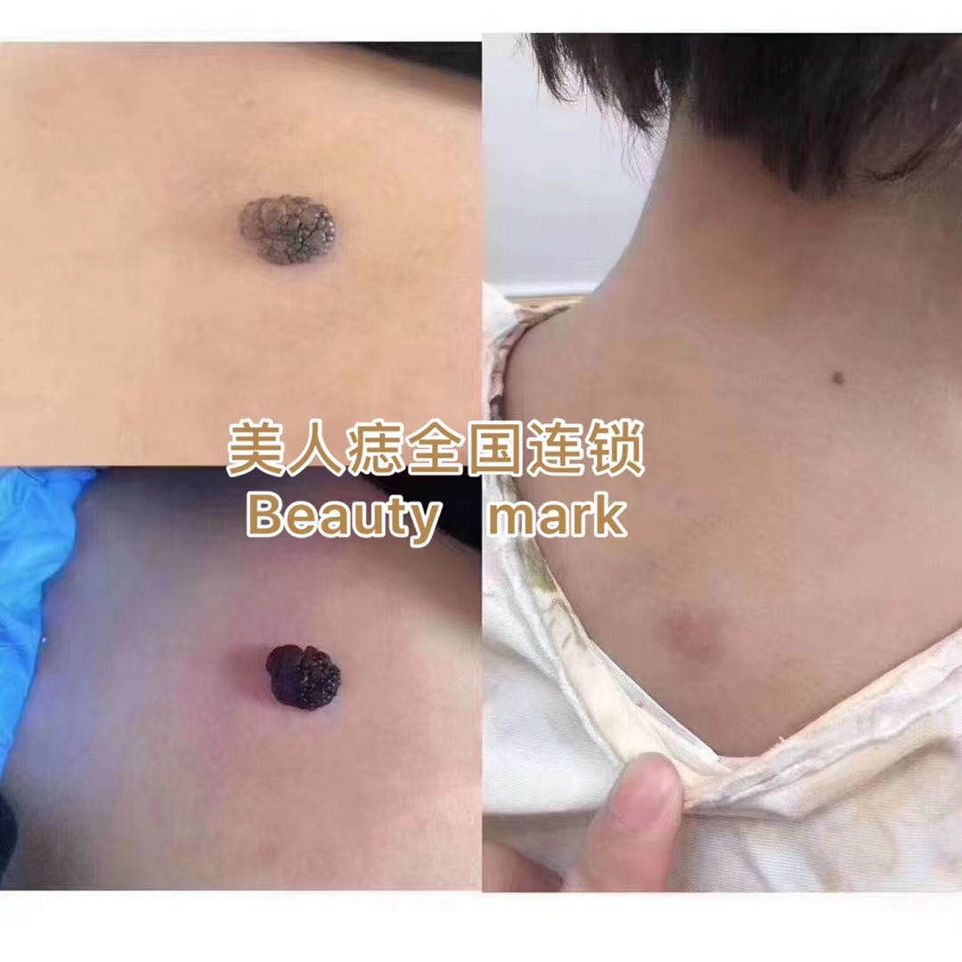 后背肉痣去除案例分享