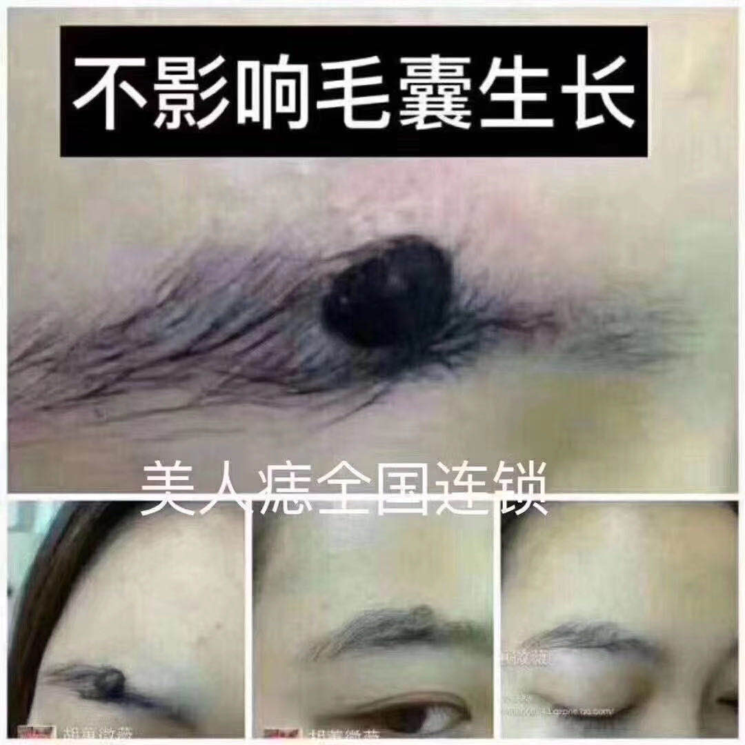 眉中痣去除案例分享