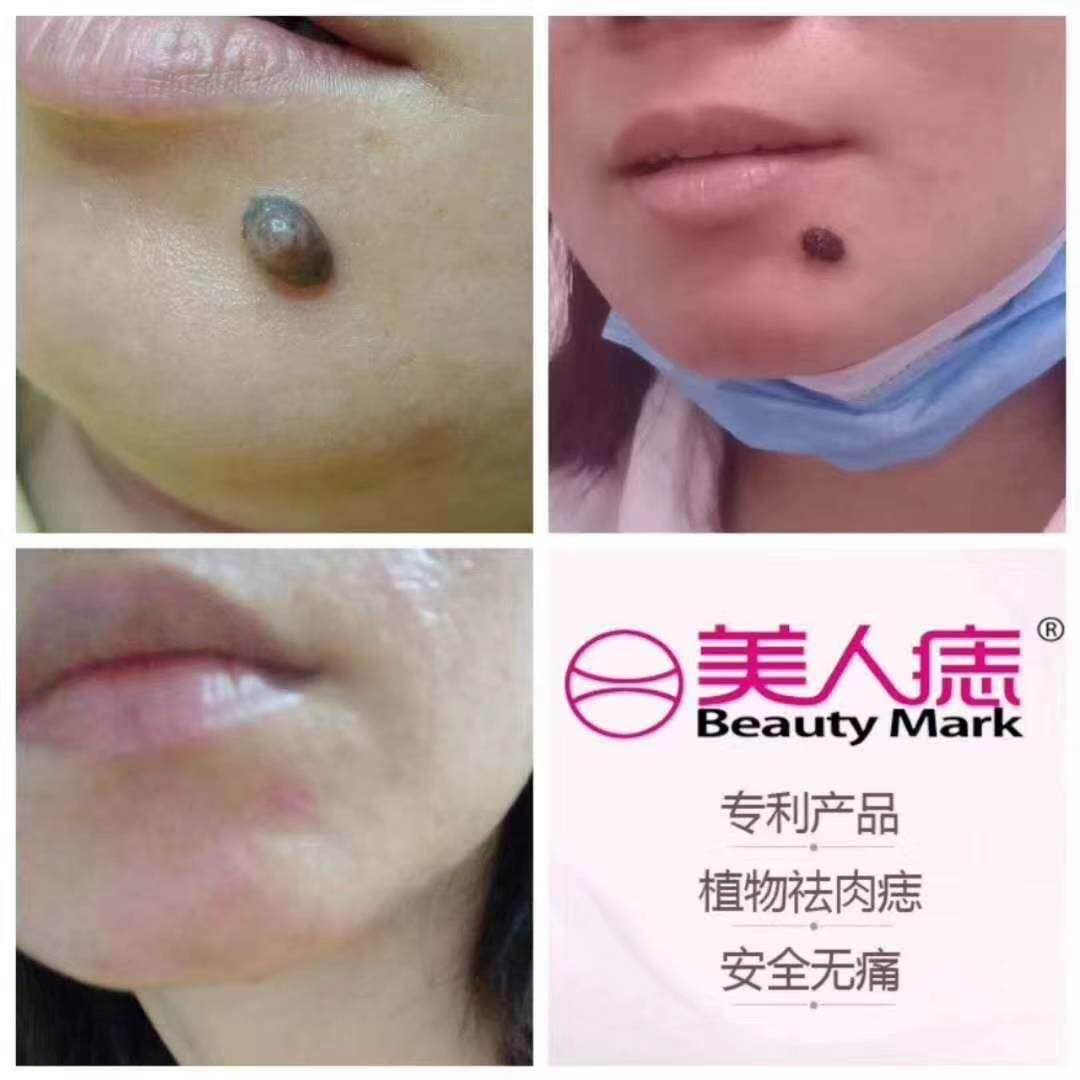 唇下肉痣去除案例分享