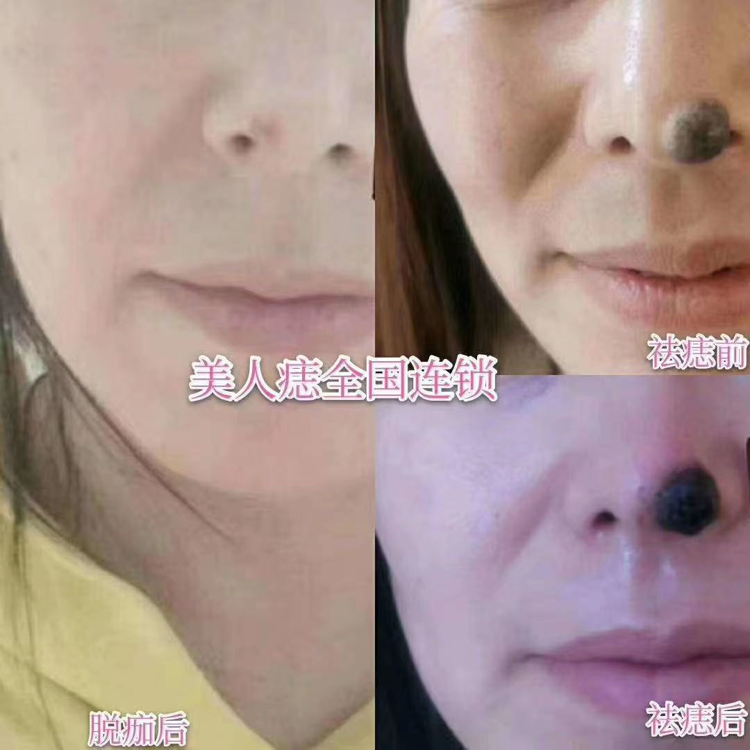 鼻上痣去除案例分享