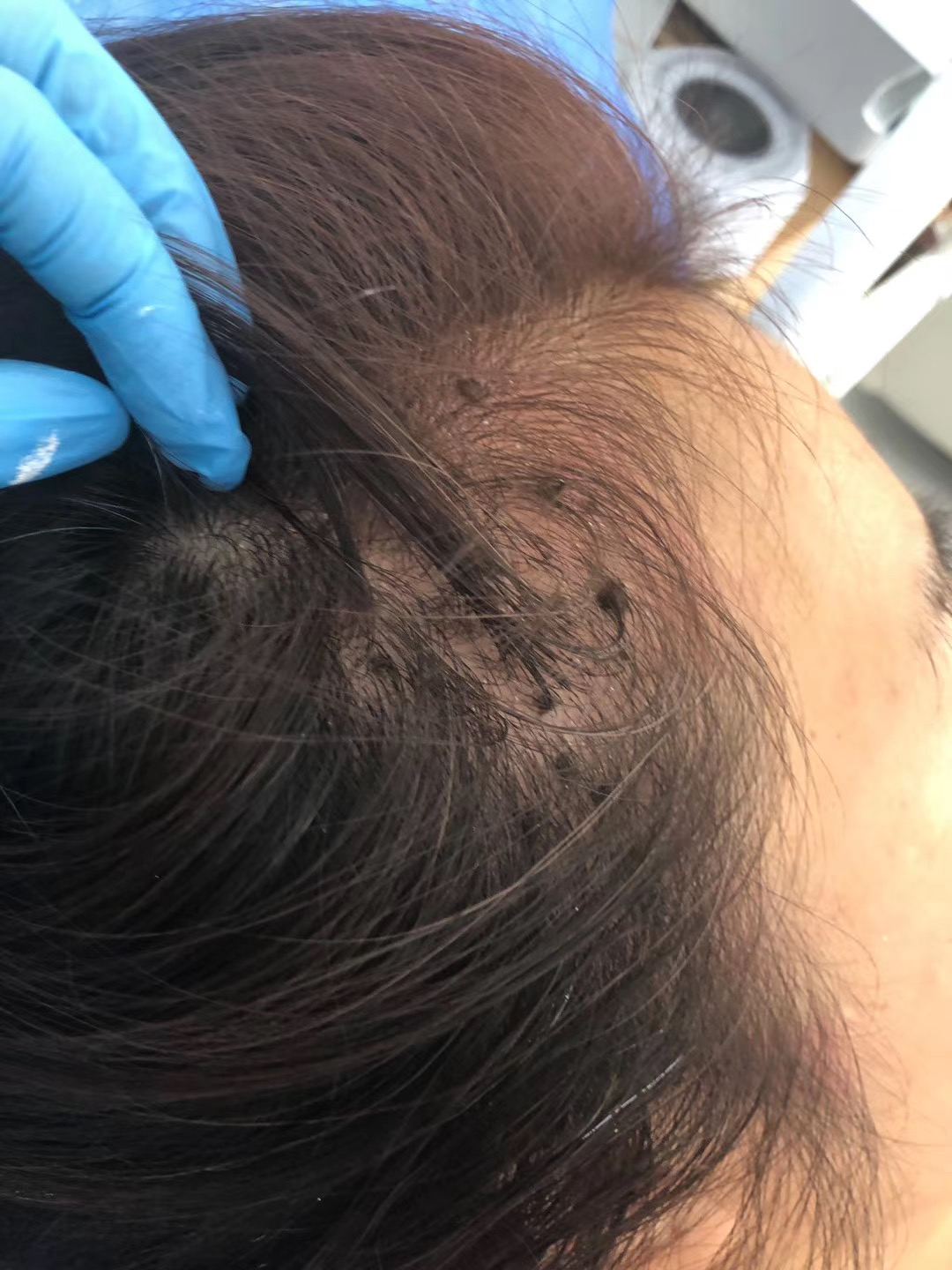 扁平疣去除案例分享