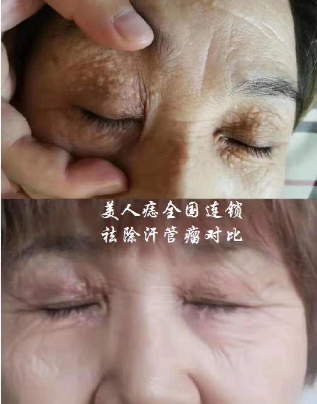 汗管瘤案例对比分享