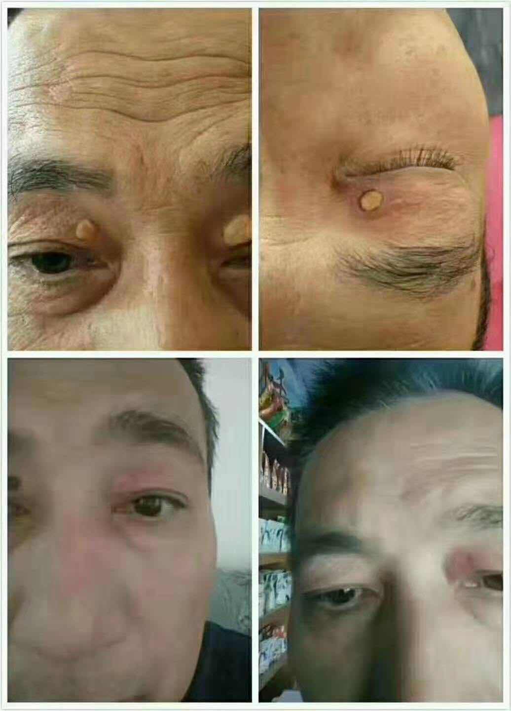 睑黄疣去除案例分享